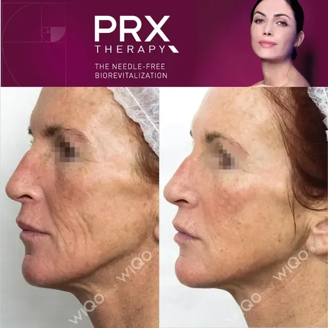 PRX Therapy ad showing side-by-side facial skin before and after treatment, with logo on purple banner