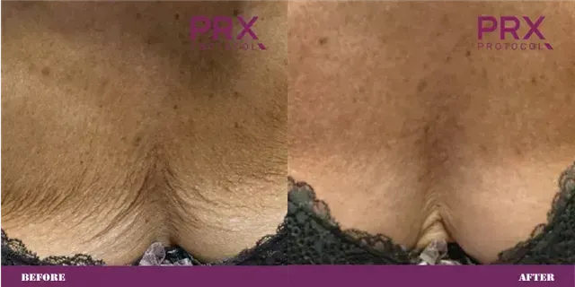 Side-by-side close-up of underarm skin: before and after, showing smoother, lighter results.