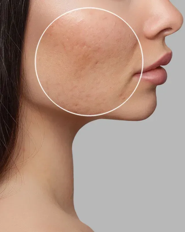 Close-up of a cheek with acne blemishes highlighted by a white circle.