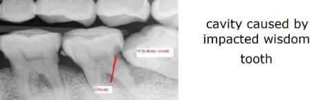 wisdom tooth removal castellano dentist 33578