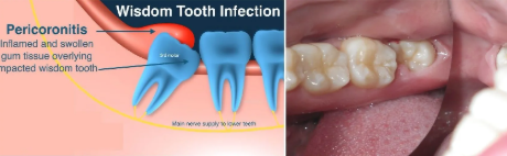 wisdom tooth delete castellano dmd