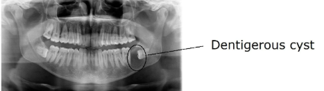 impacted wisdom tooth