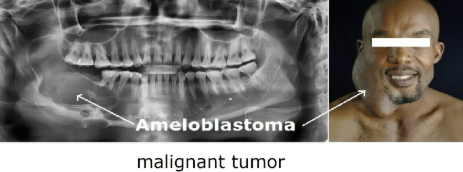ameloblastoma tumor