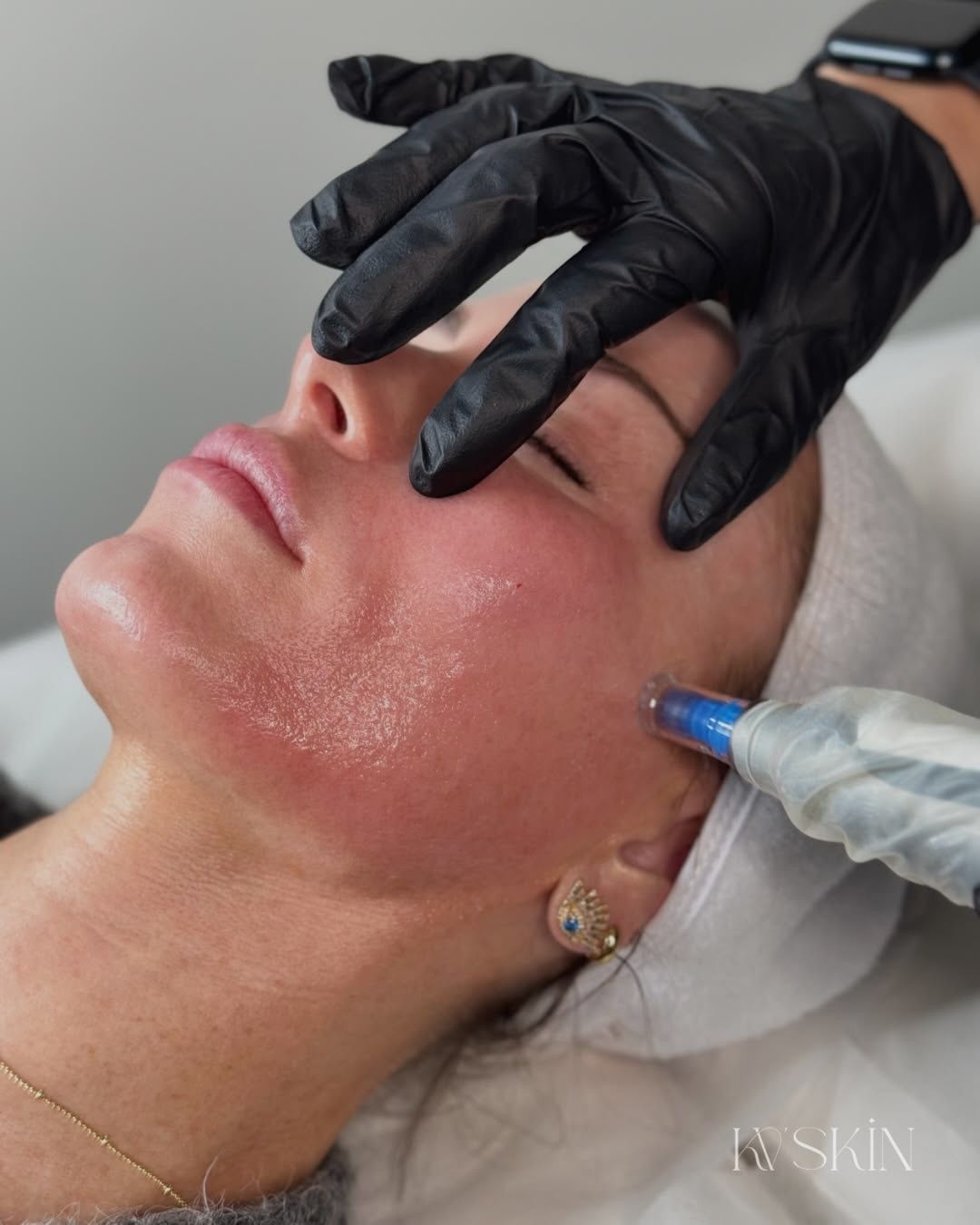 Top Rated Med Spa Bellevue WA for Botox and Fillers