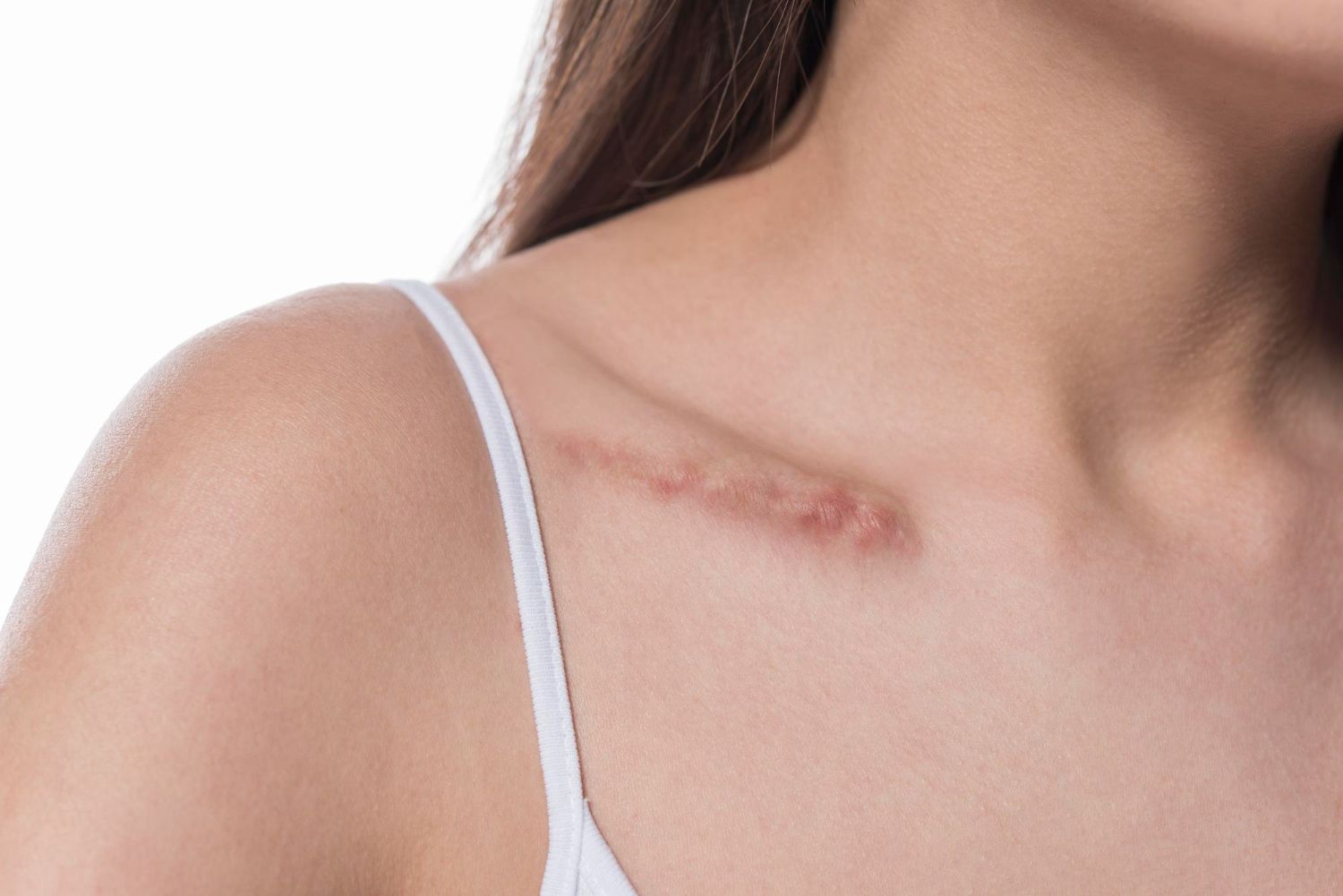 Close-up of a shoulder with a red, raised scar on the collarbone