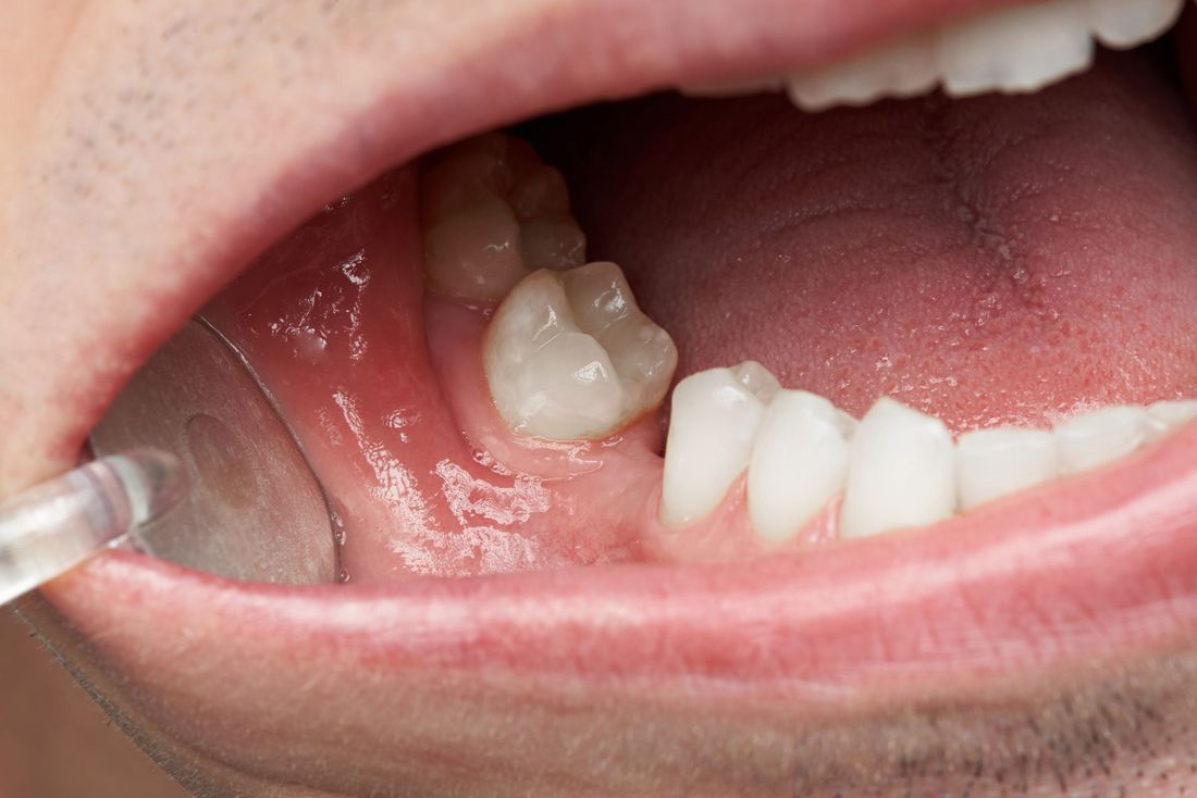 perdita dei denti