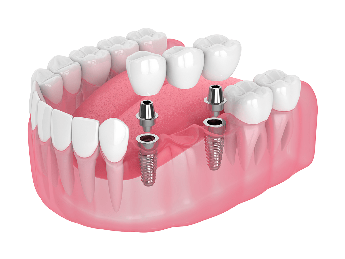 chirurgia implantare