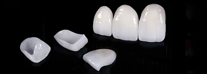 faccette dentali