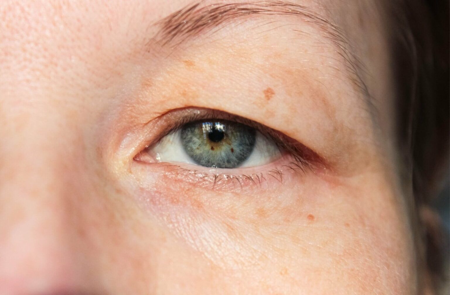 image of a woman with droopy eyelid representing how to fix droopy eyelids without surgery
