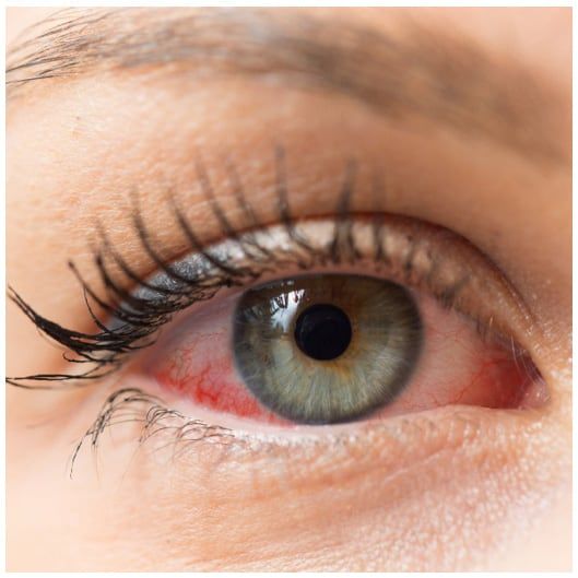 Before Dry Eye Treatment