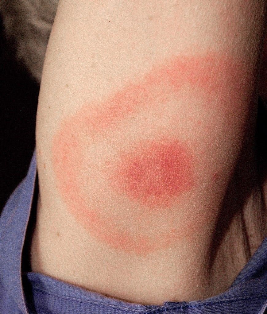A close up of a person 's arm with a red spot on it.