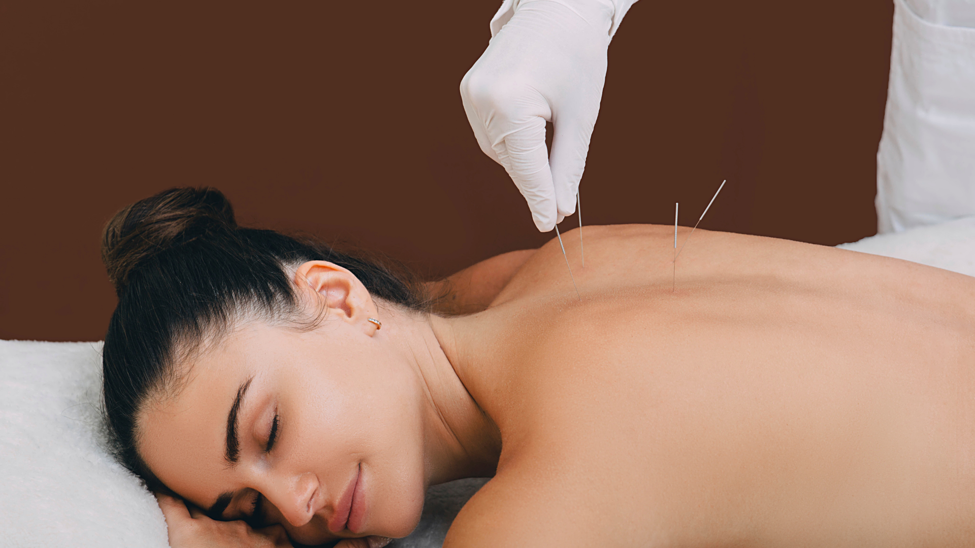 Woman receiving acupuncture treatment while lying face down on a massage table