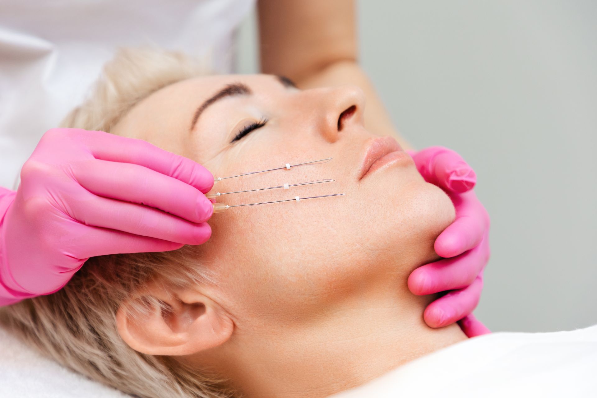 Woman receiving facial thread lift; pink-gloved hands hold threads near her cheek.