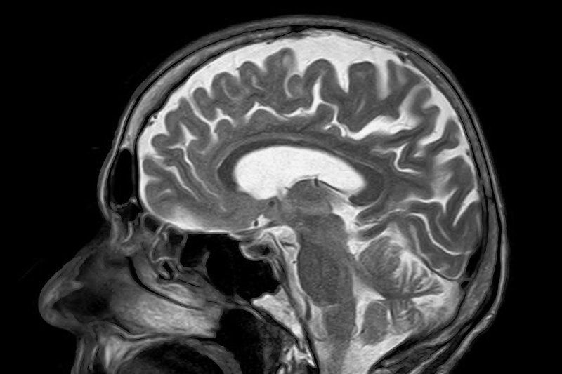Sagittal brain MRI scan showing white and gray matter structures