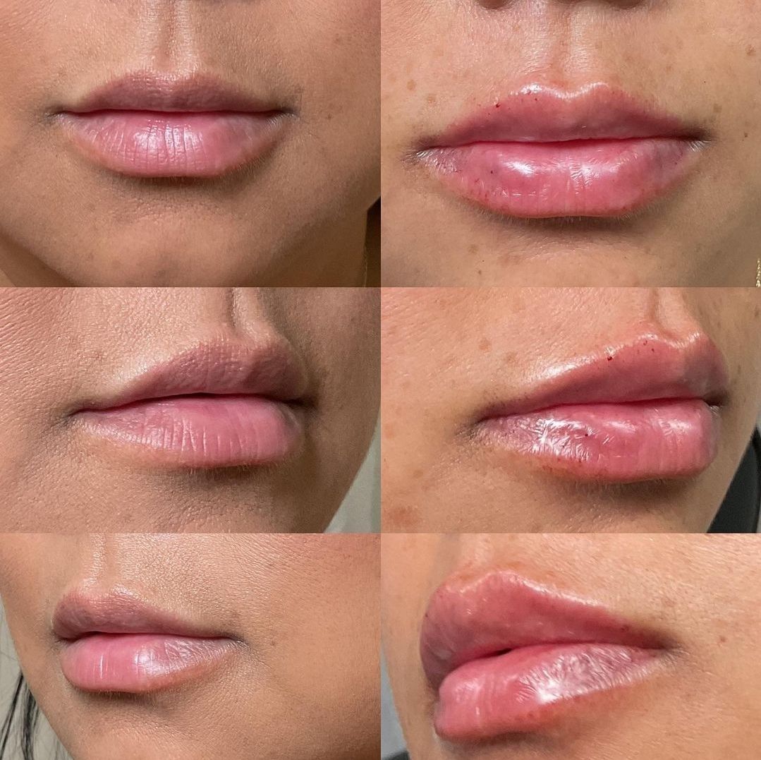 Before & After Lips Filler