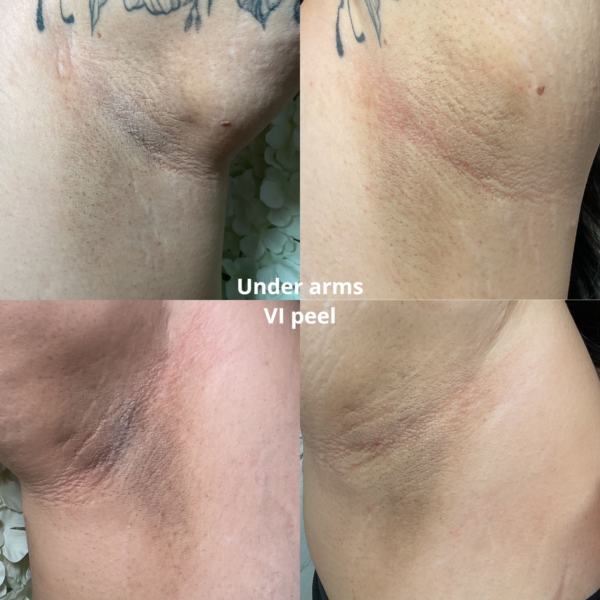 Four pictures of a person 's under arms with the words under arms vi peel at the bottom