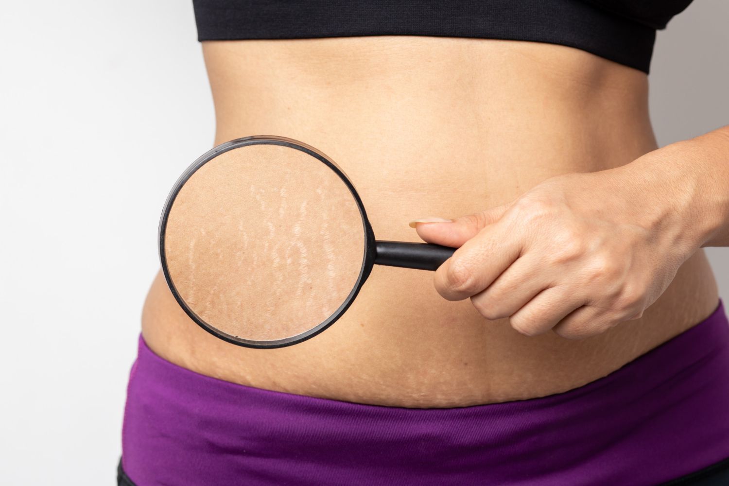 Hand holding a magnifying glass over stretch marks on a bare abdomen above purple pants