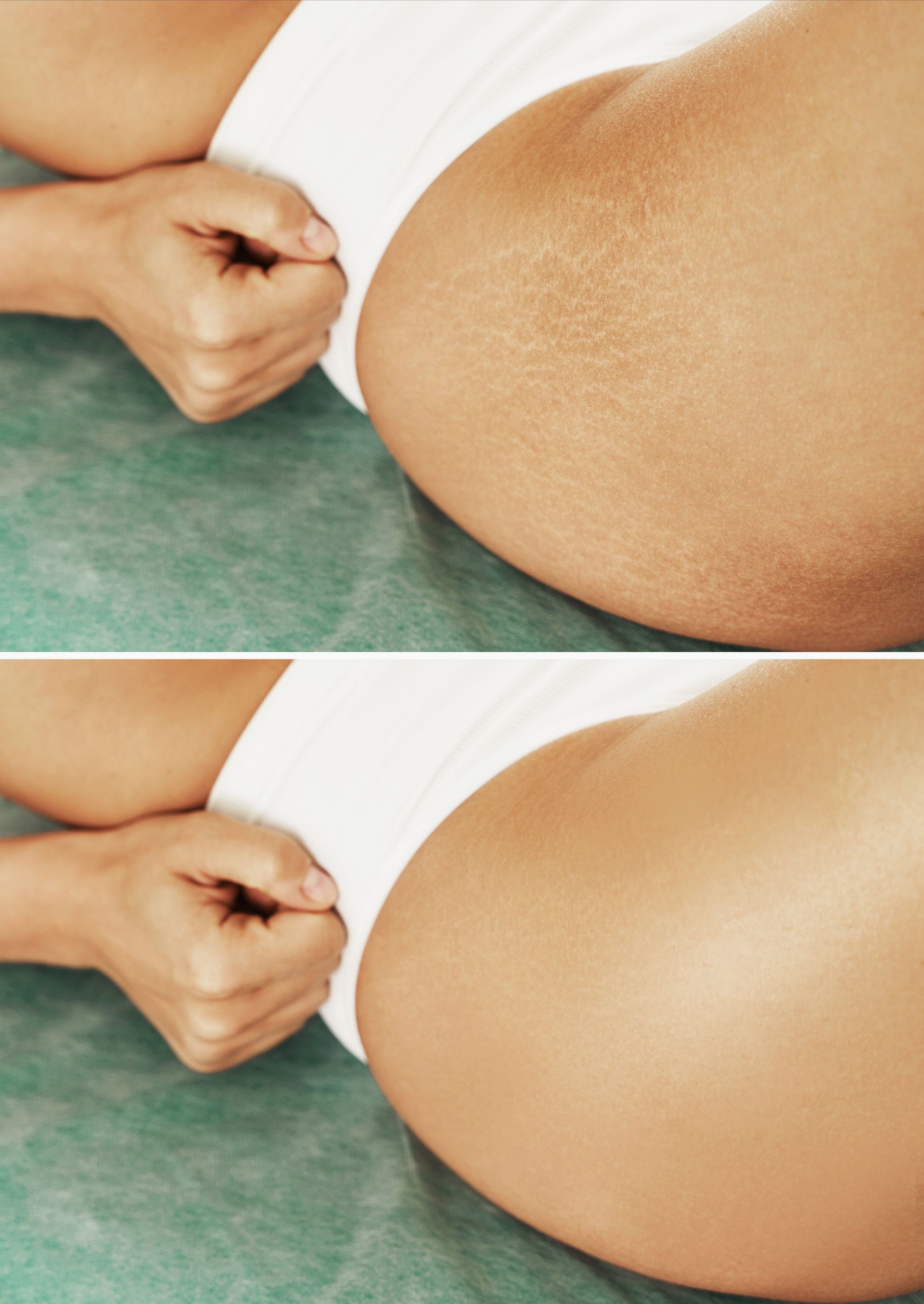 closeup female hip with comparison before after stretch marks treatment