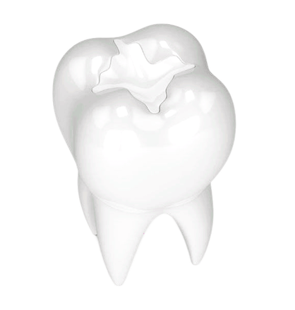 White 3D tooth illustration with a cavity or filling on the top surface