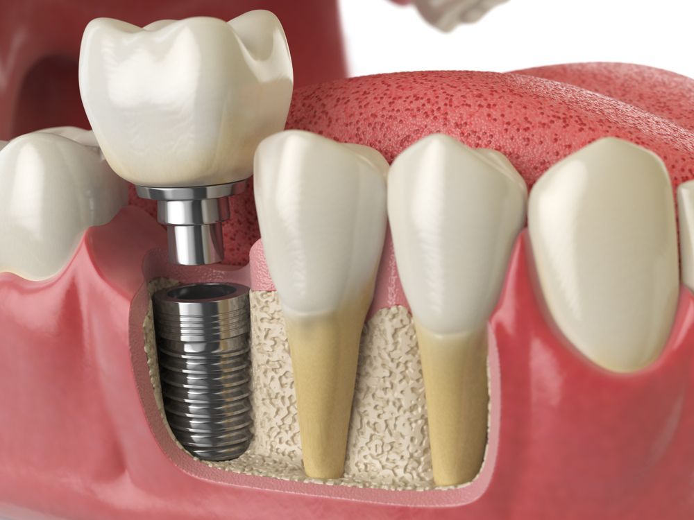 Dental implant diagram, showing a titanium post in the jawbone with a crown attached.