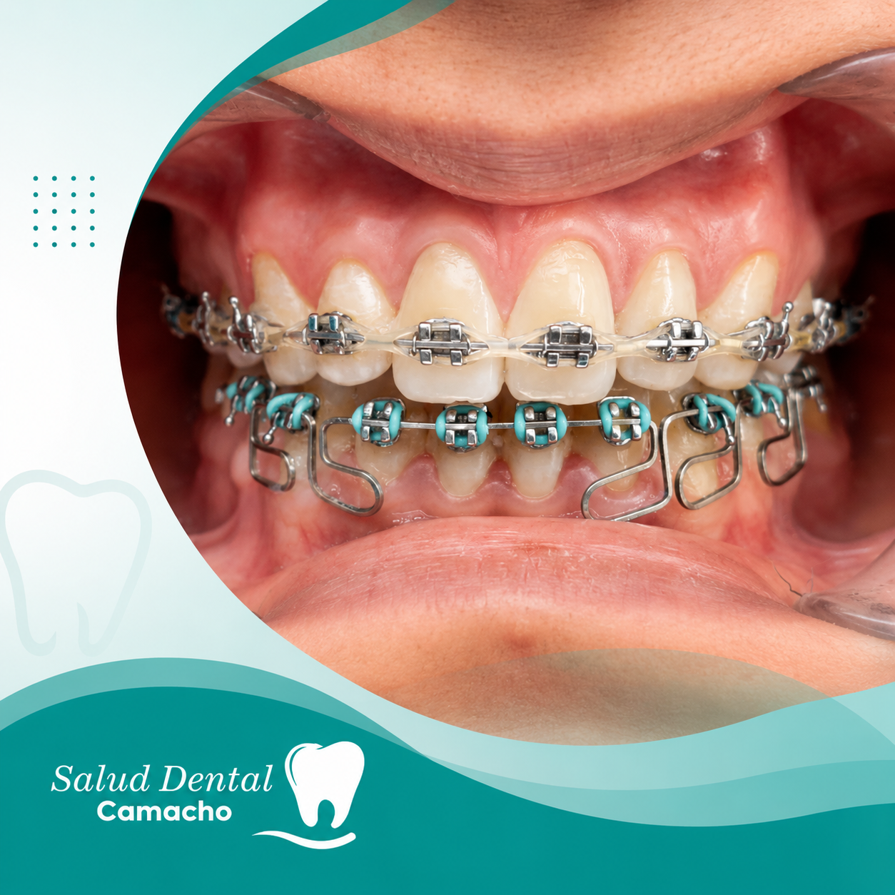 Primer plano de dientes con aparatos de ortodoncia y elásticos turquesa, en un gráfico promocional de una clínica dental.