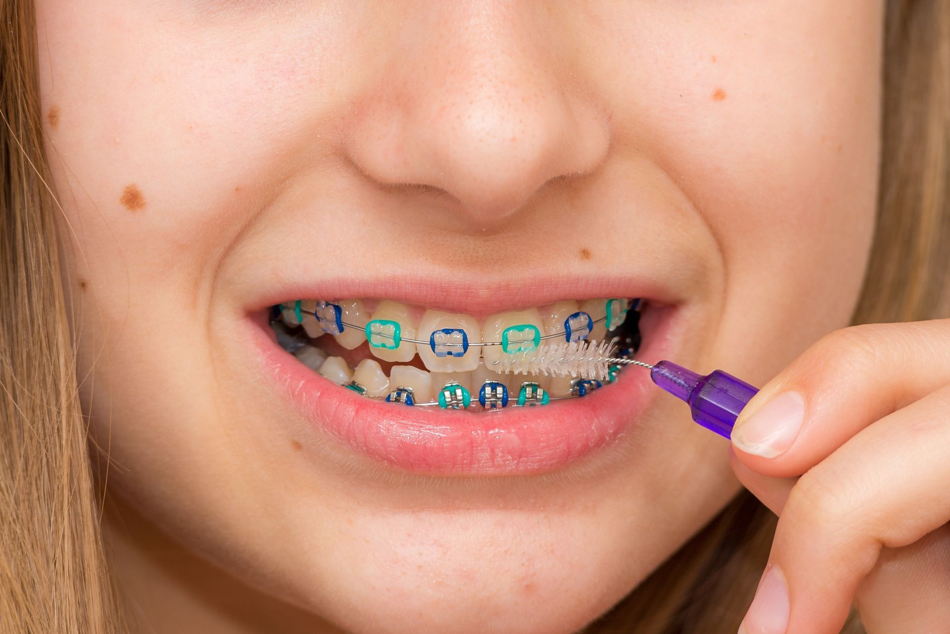 Orthodontics For Children – Riverton, UT – Welton Orthodontics