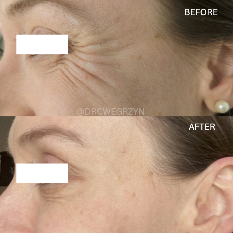 A before and after photo of a woman 's face with wrinkles.