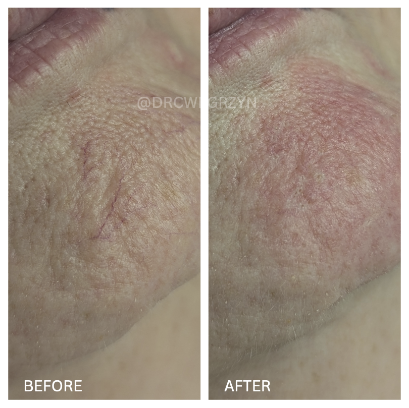 A before and after photo of a person 's face.