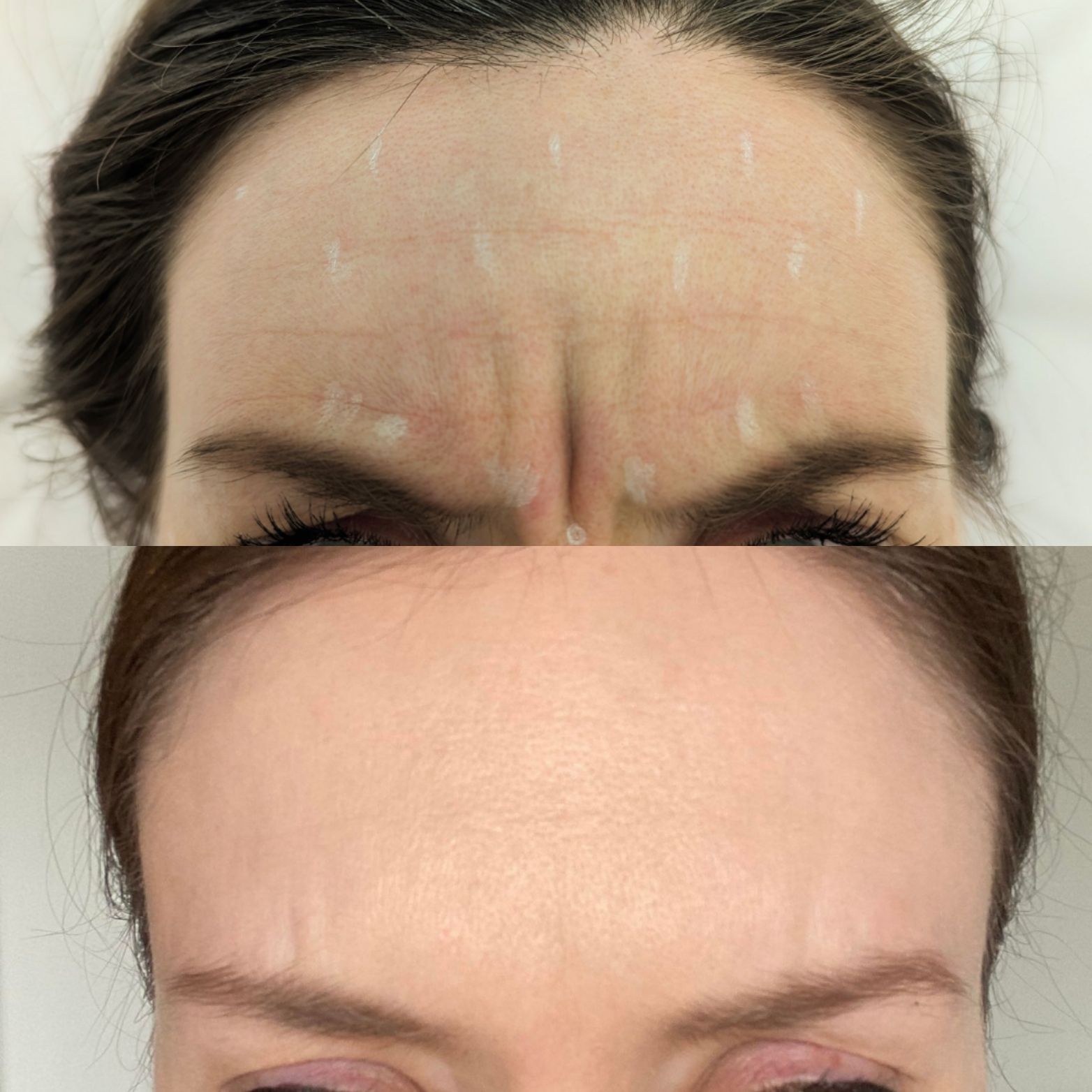 A woman 's forehead before and after botox injections.