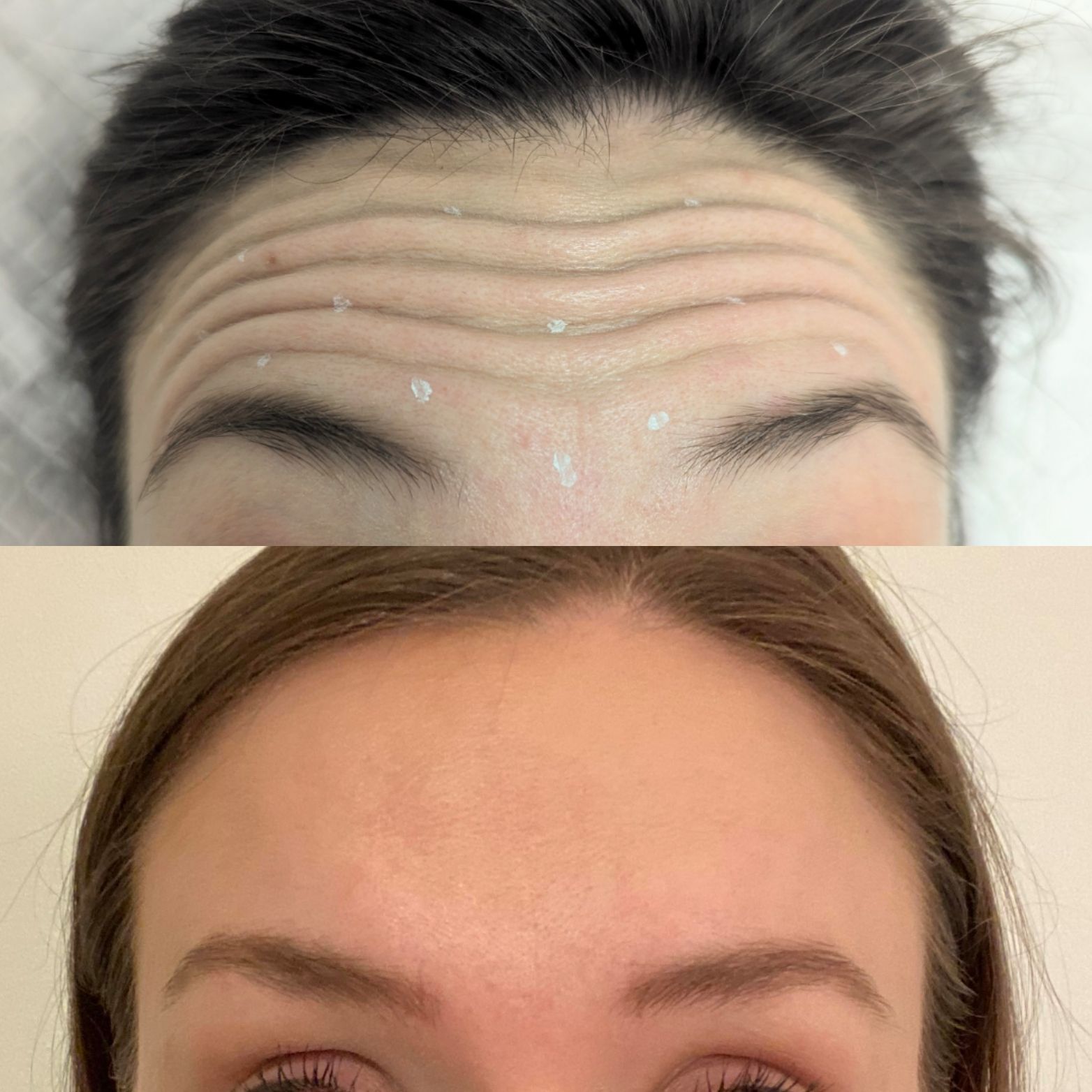 A woman 's forehead before and after botox injections.