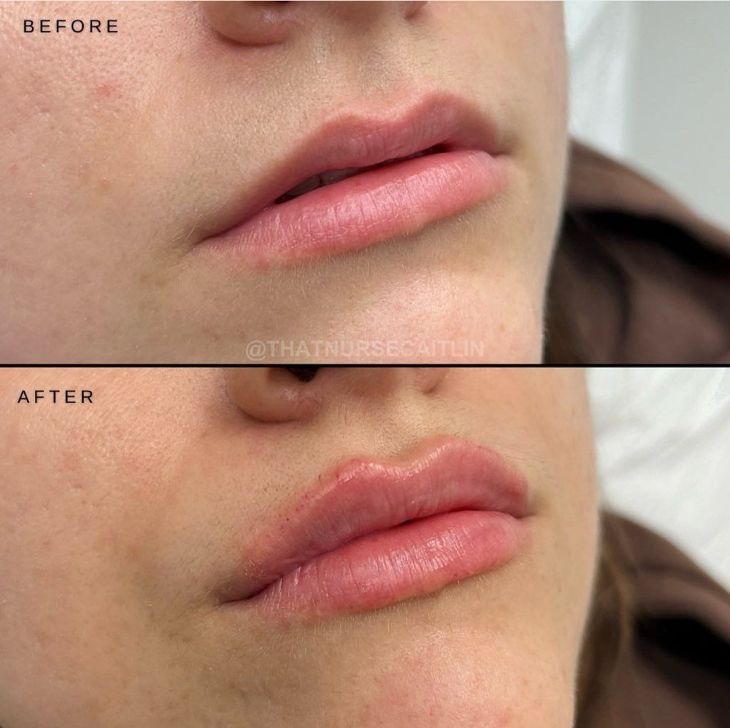 A before and after picture of a woman 's lips.