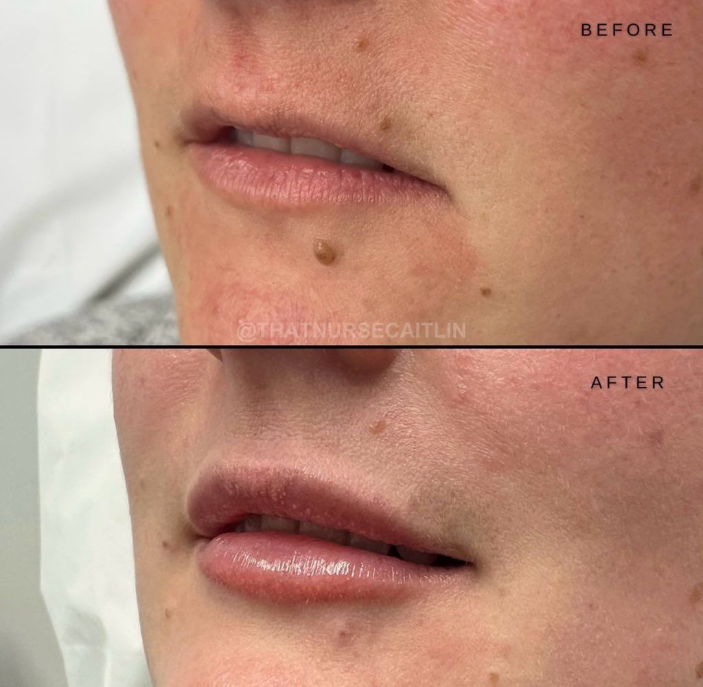 A before and after photo of a woman 's lips.