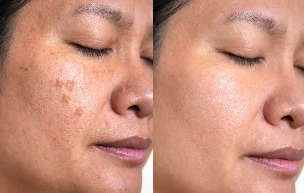 Woman's face before and after treatment, showing reduction in age spots and improved skin tone.