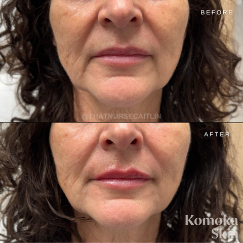 Before-and-after close-up of a person’s lower face showing smoother lips and chin after treatment