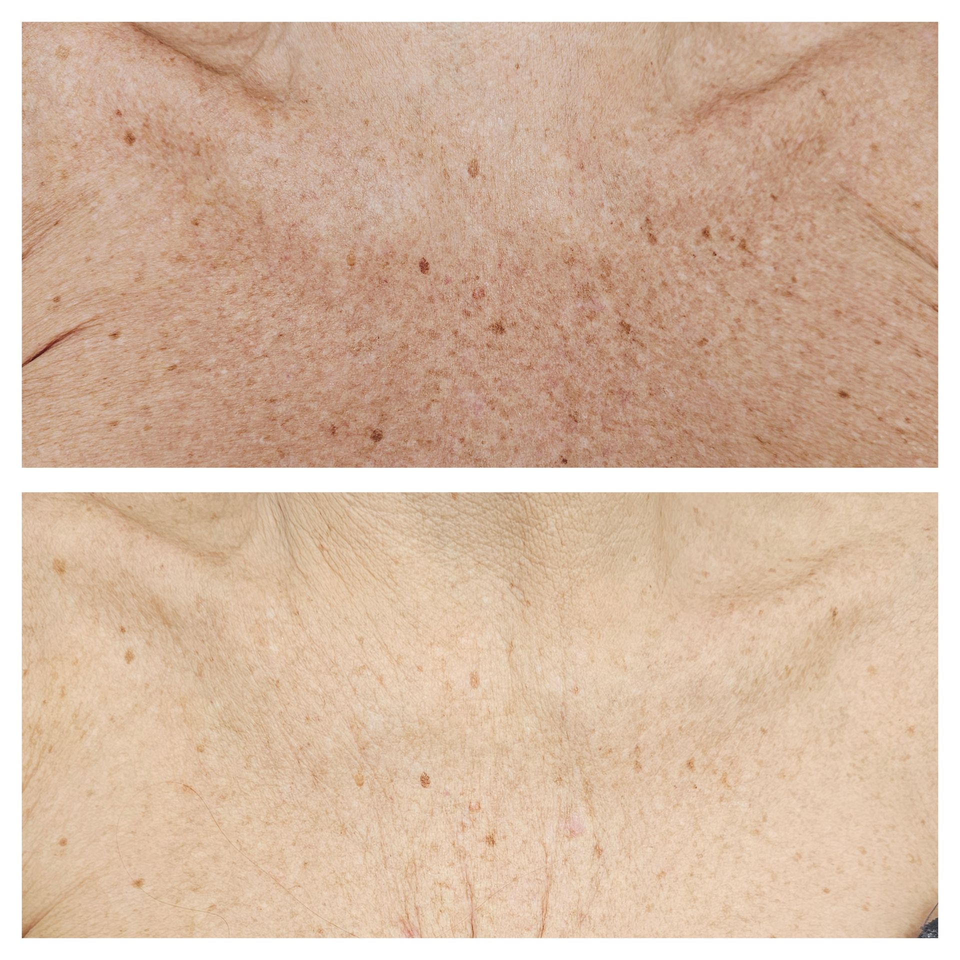 A before and after photo of a woman 's neck and chest.