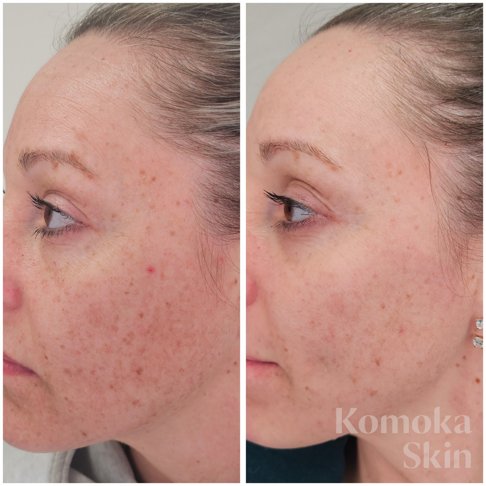 Side-by-side profile photos of a cheek showing before and after skin improvement, with reduced redness and blemishes