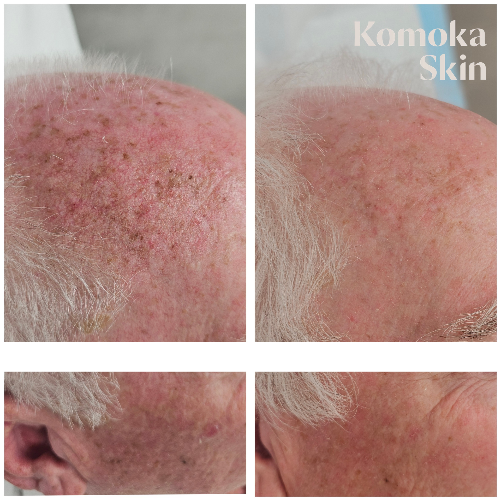 Close-up before-and-after scalp photos showing red, flaky skin and a smoother, calmer patch after treatment