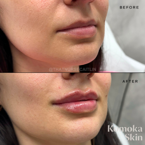 Before-and-after close-up of lips, with fuller, glossier lips in the after image.