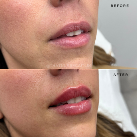 Before-and-after close-up of lips, showing a pinker, fuller look after treatment.