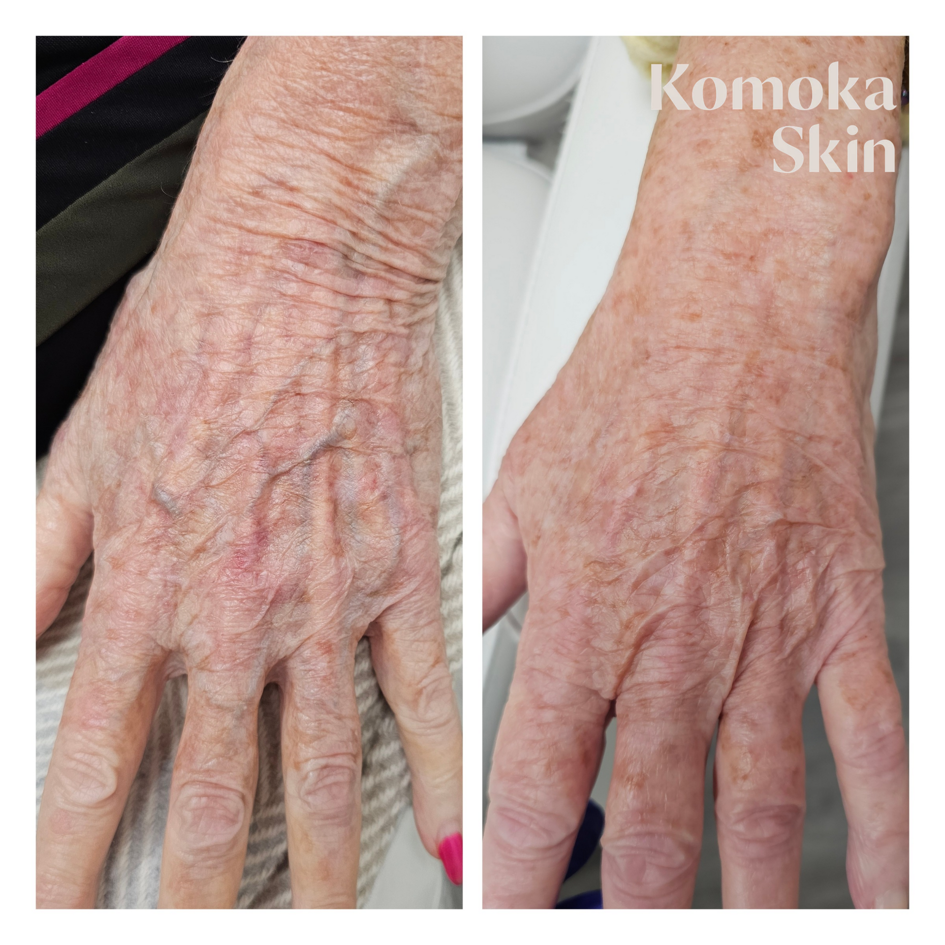 Close-up comparison of a wrinkled hand, showing dry skin on the back of the hand.