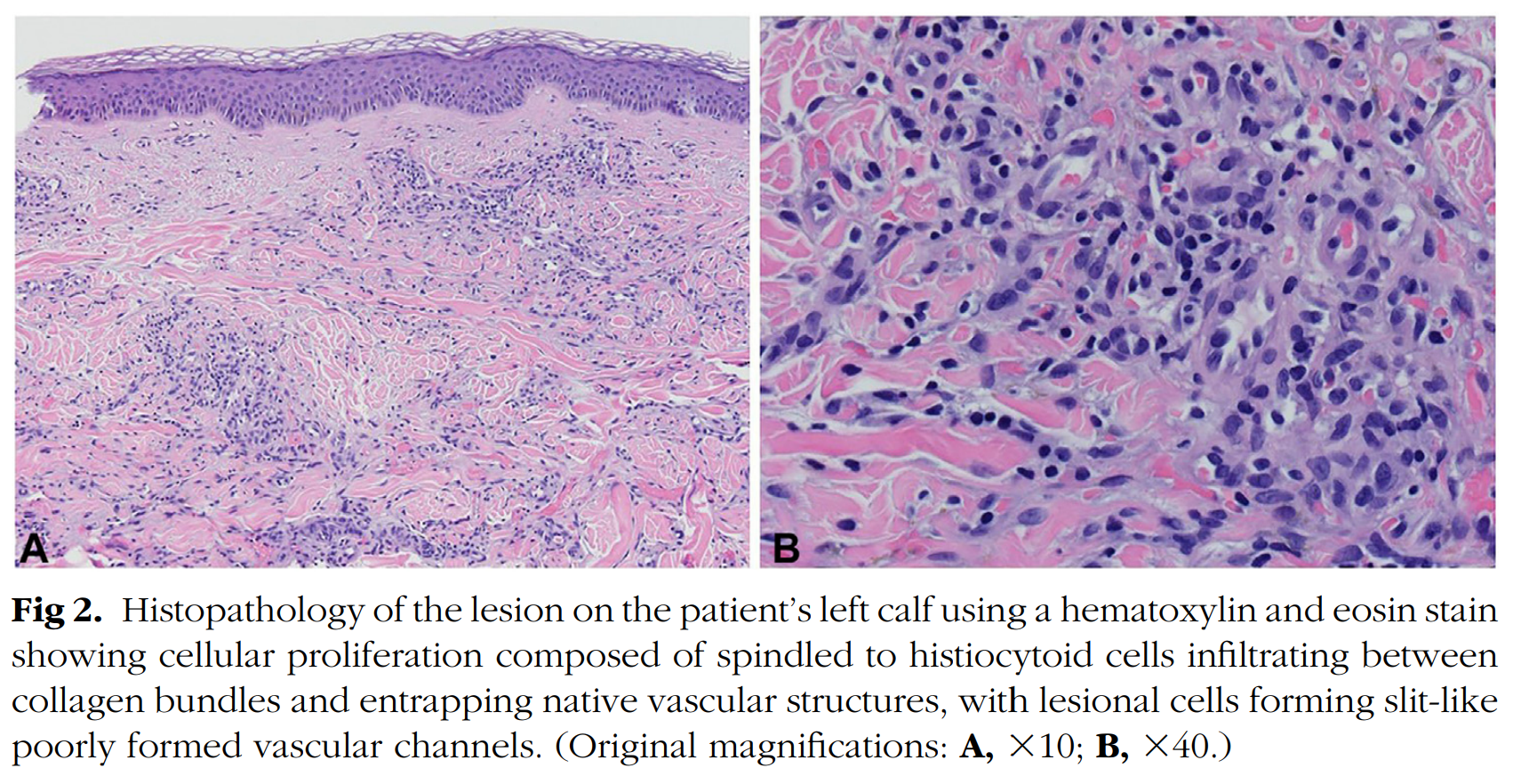 Figure 2 of Kaposi Sarcoma