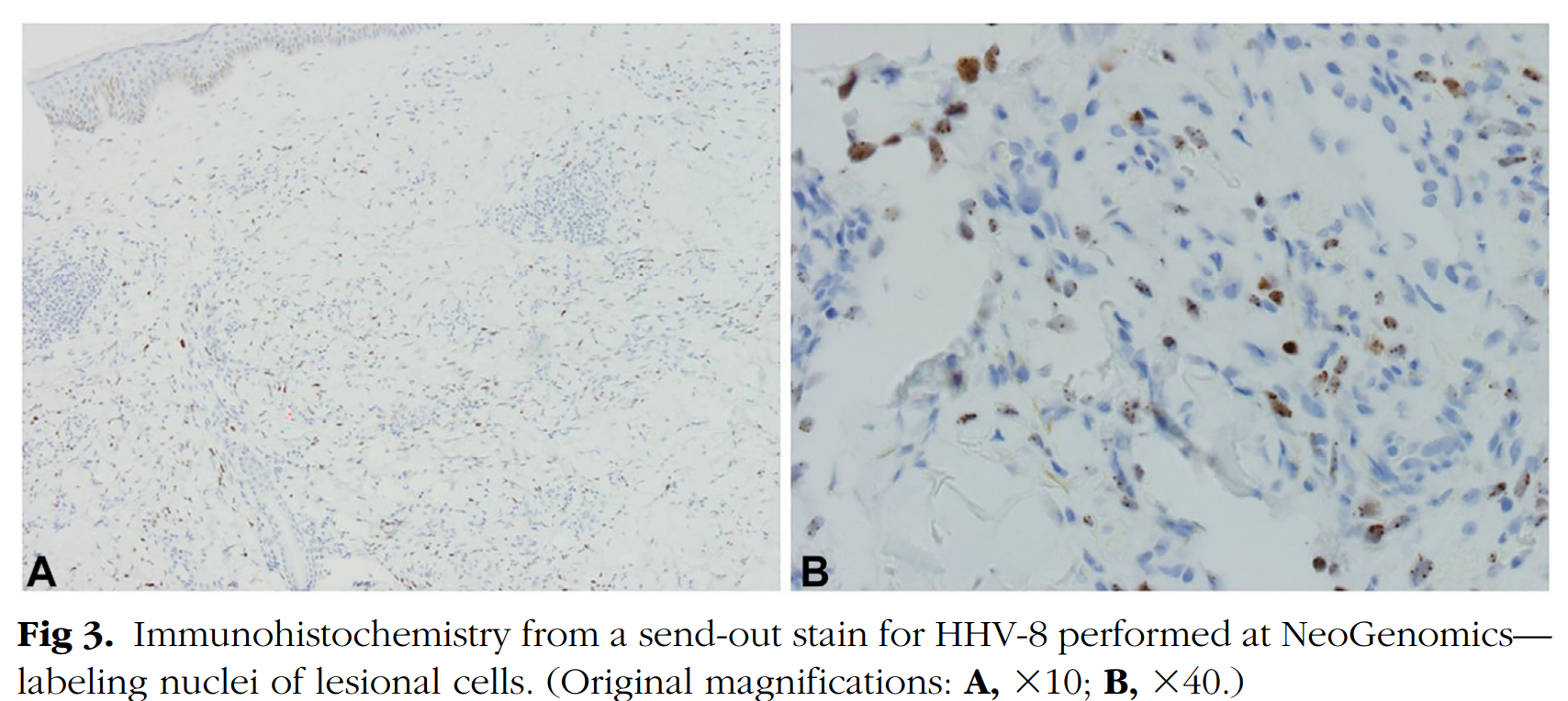 Figure 3 of Kaposi Sarcoma