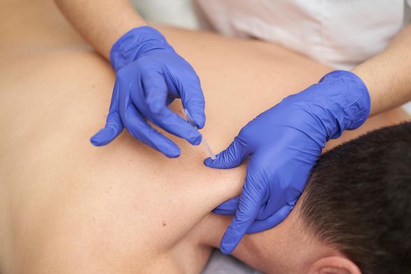 Physiotherapist-treating-an-overload-with-dry-needling