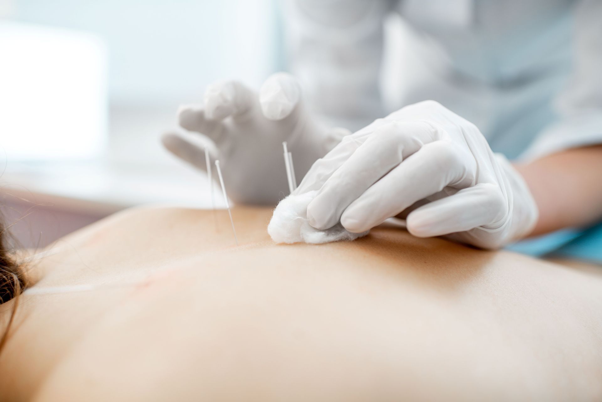 A person is getting acupuncture medical treatment. A person is getting acupuncture medical treatment.