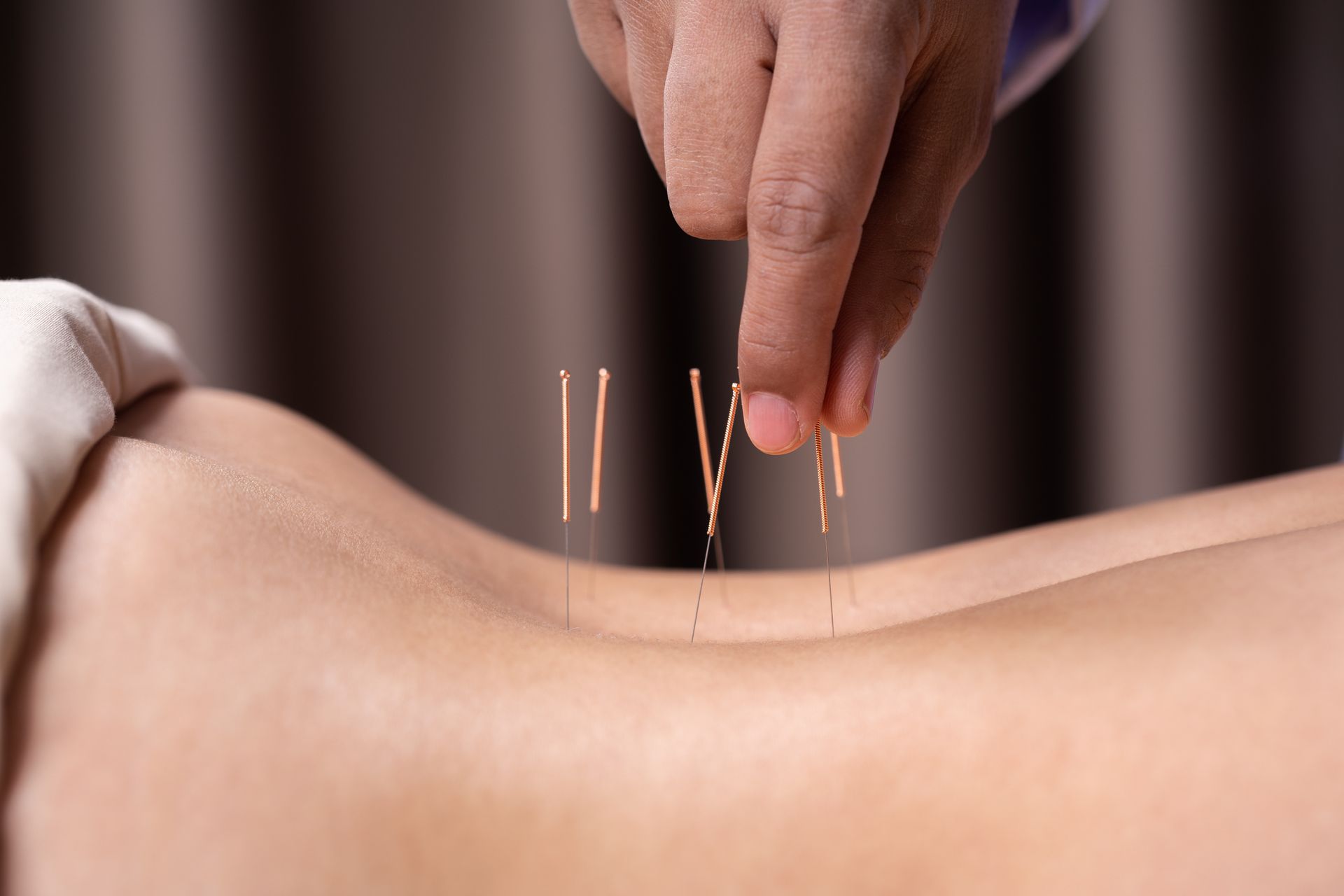 Traditional Acupuncture Treatment