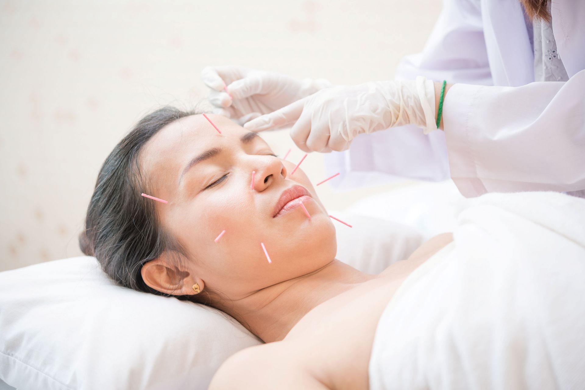A patient receiving facial acupuncture treatment from a specialist at a local acupuncture clinic. A patient receiving facial acupuncture treatment from a specialist at a local acupuncture clinic.