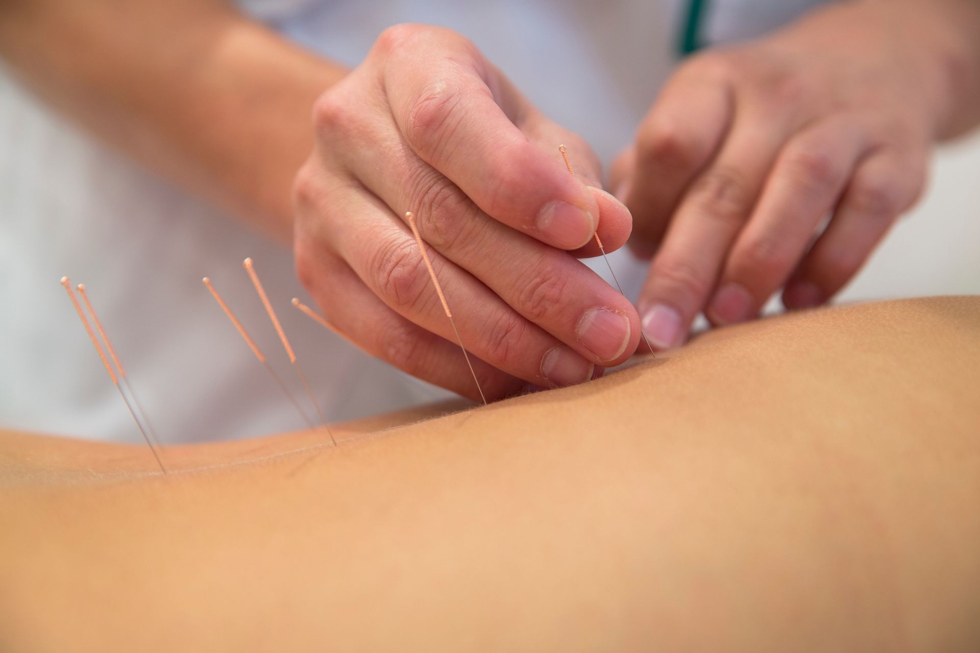 Acupuncture Treatment 
