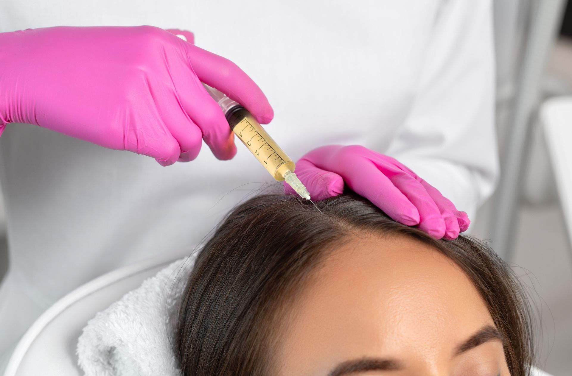 Personne recevant une injection de PRP pour la perte de cheveux, avec des mains gantées de rose tenant une seringue sur le cuir chevelu.