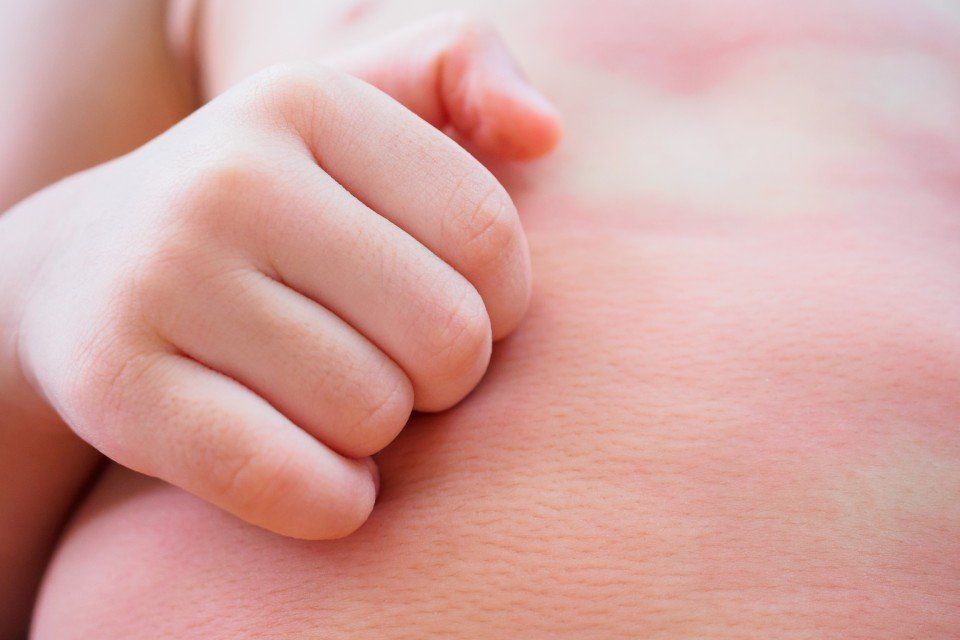 disturbi dermatologici dei bambini