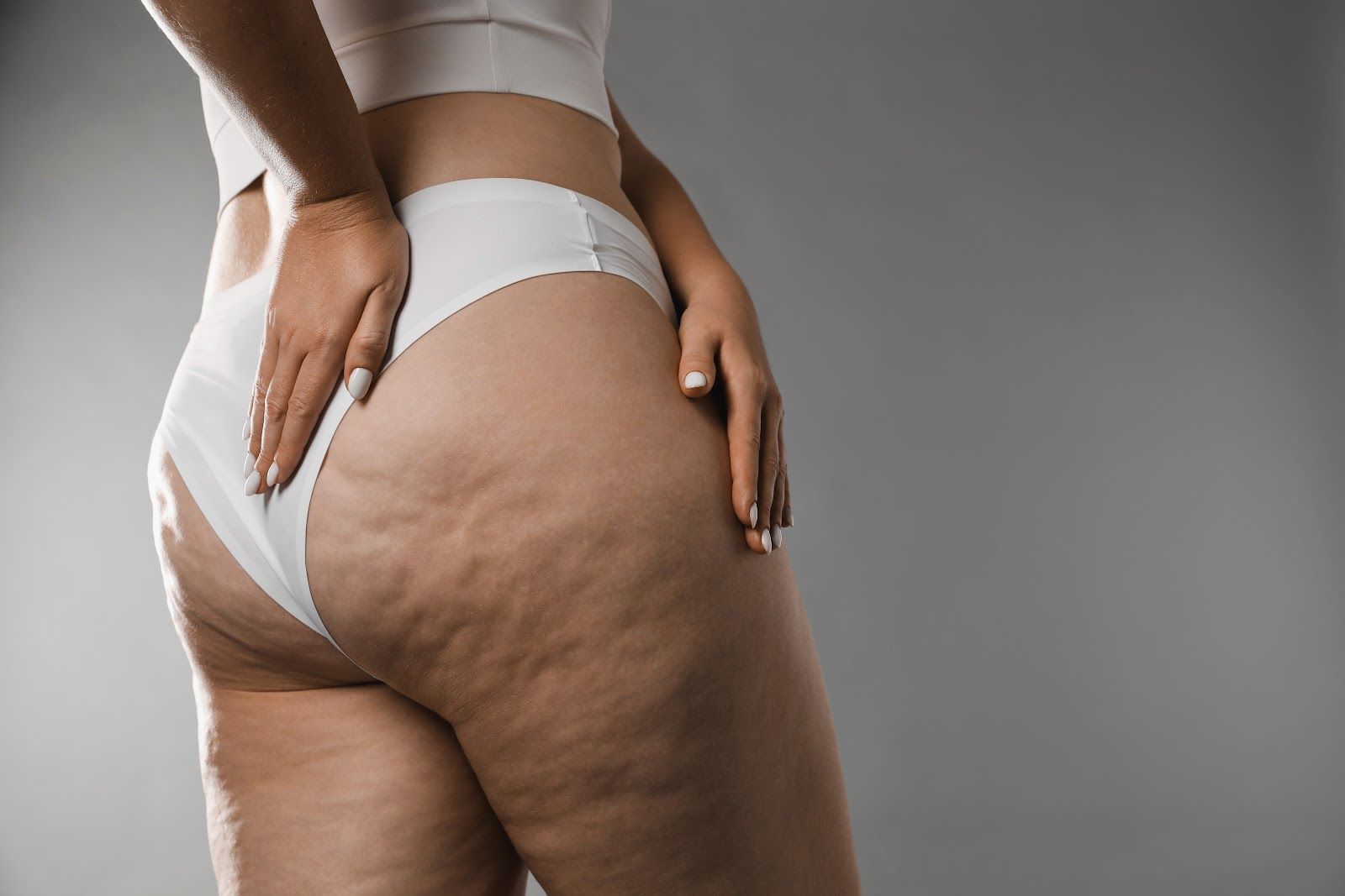 Person in white underwear showing stretch marks on hip and thigh against a gray background